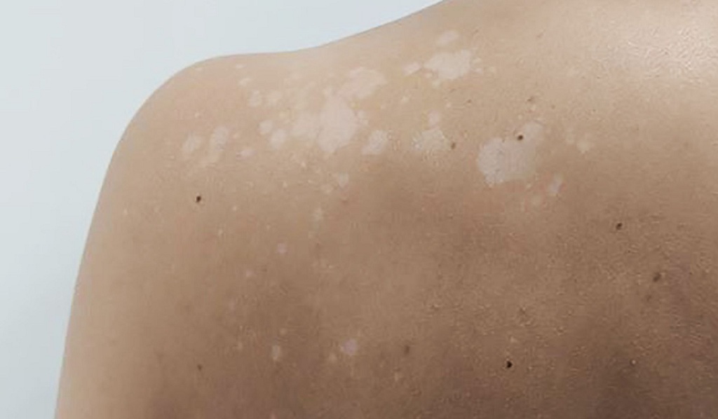 now-cure-white-spots-from-tanning-with-these-simple-remedies